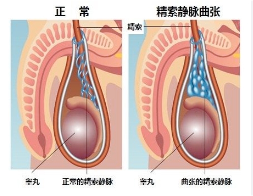 男性健康：精索静脉曲张的预防与治疗