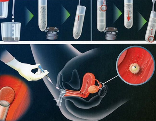 人工受精：揭秘复杂过程和费用