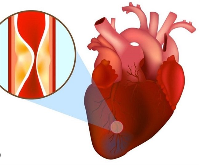 心肌梗塞的警示信号：了解症状及紧急处理