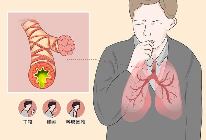 变异性哮喘症状及原因详解：呼吸困难、咳嗽、精神压力