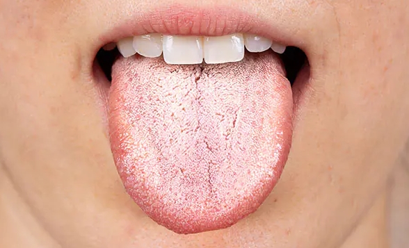 舌苔发白背后的健康信号