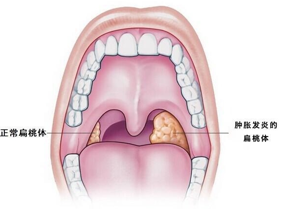 扁桃体发炎如何调理？扁桃体发炎饮食小贴士