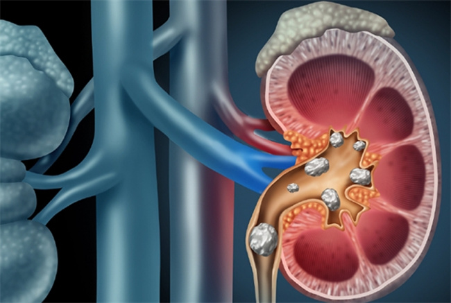肾结石疼痛的专业解读与快速止痛方法