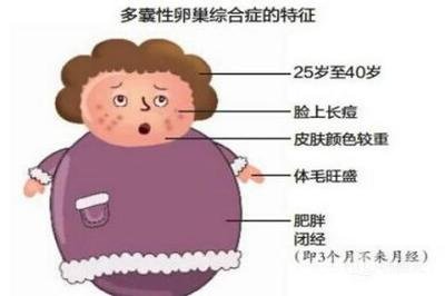 多囊性卵巢女性感染新冠风险增51%！效法患多囊艺人小祯减重运动，并打疫苗做好防疫工作