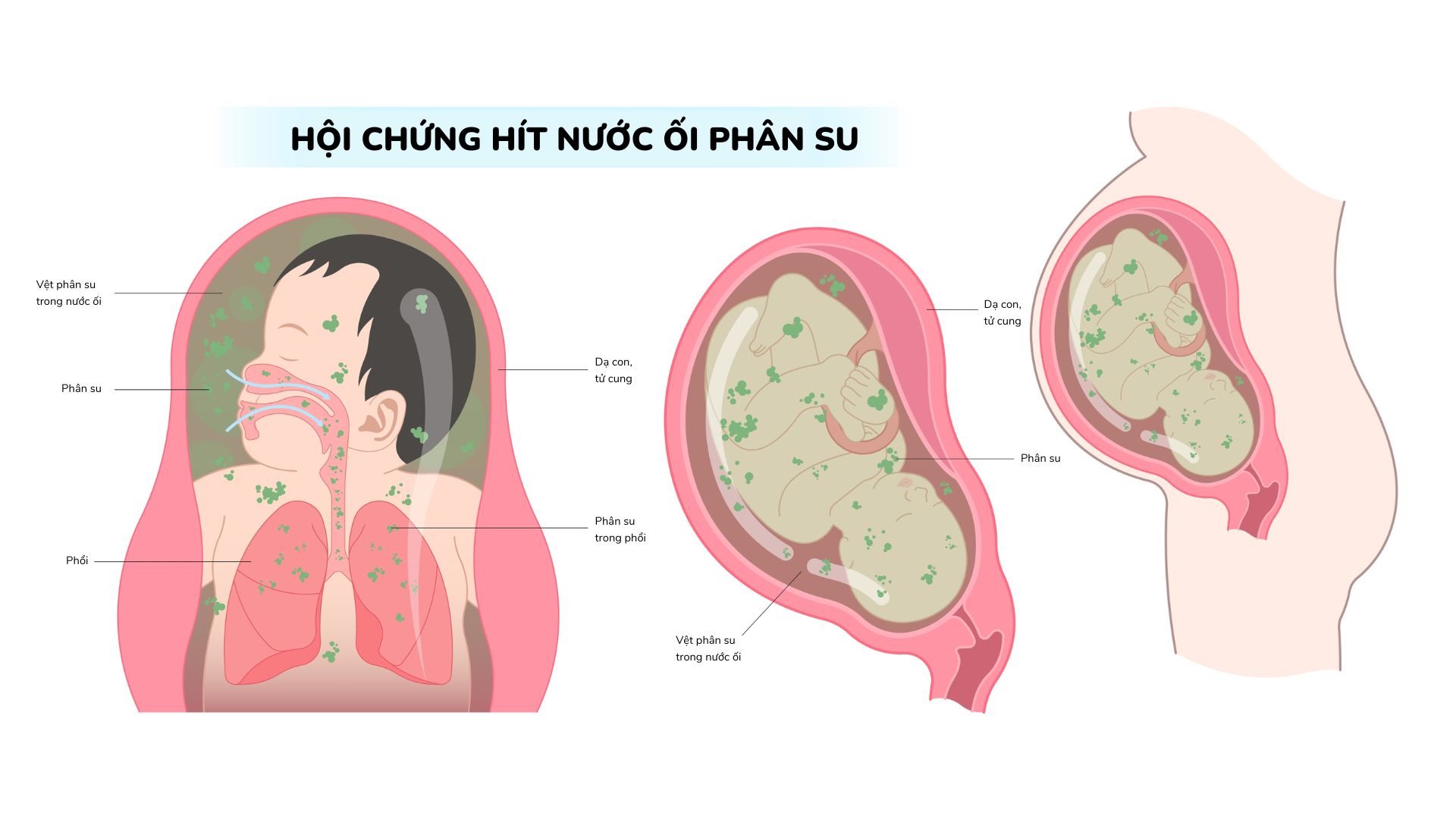 什么是婴儿的胎粪?产妇羊水吸入综合症需要知道