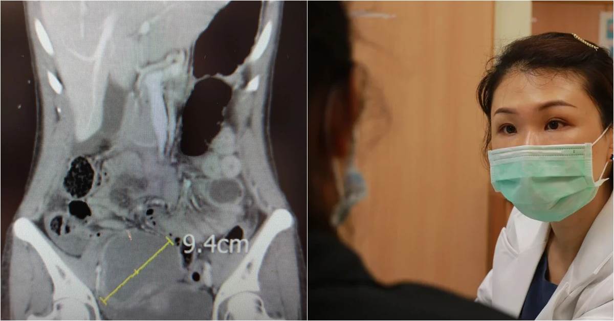 经痛别轻忽，轻熟女「苹果大」巧克力囊肿破裂挂急诊