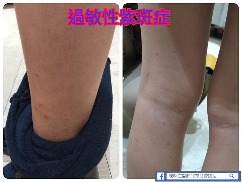 8岁女童腹痛「脚踝、屁股」布紫斑！儿科医师警告：恐肾衰竭！