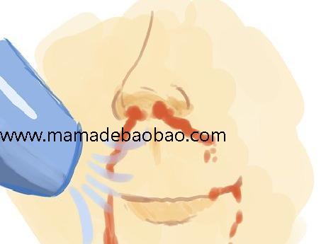 3种方法来在不伤害自己的情况下流鼻血（抹开的或干的鼻血）