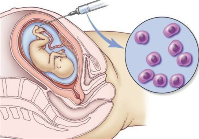 解密羊水穿刺：胎儿健康检查的关键一环