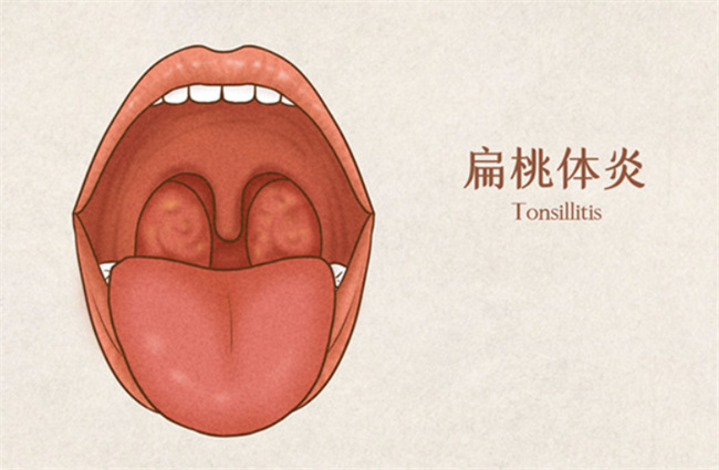  扁桃体发炎引发发烧：如何正确治疗？