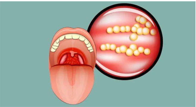  扁桃体发炎引发发烧：如何正确治疗？