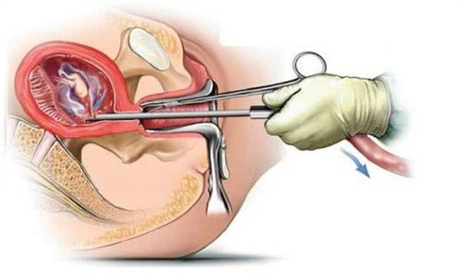 紧急避孕药 vs 人工流产：哪个伤害更大