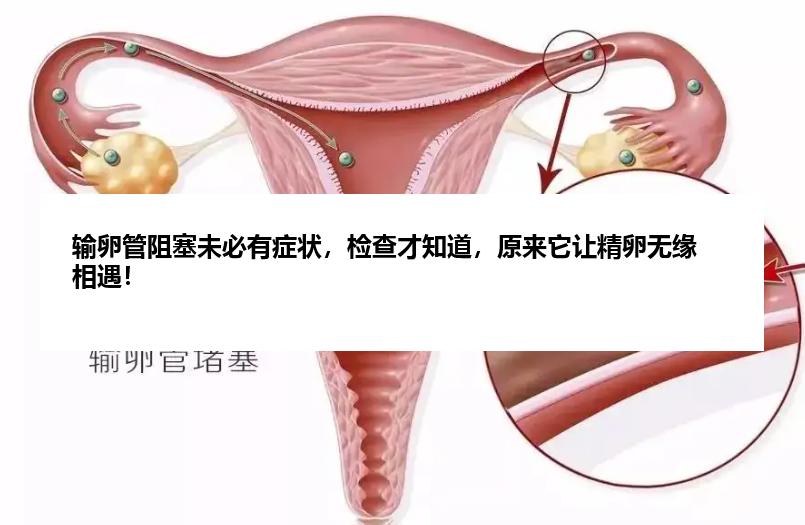 输卵管阻塞未必有症状，检查才知道，原来它让精卵无缘相遇！