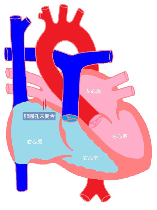 宝宝心脏有洞？先别紧张！了解卵圆孔未闭合是什么状况。